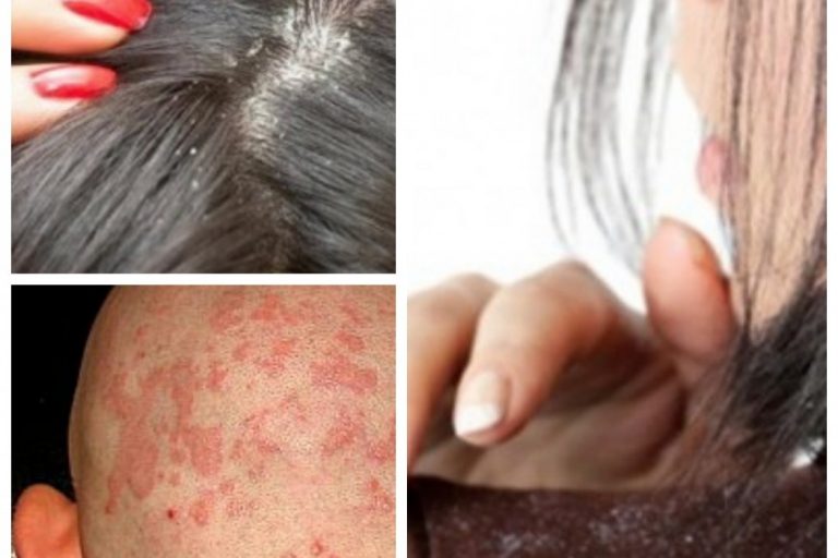 Effectively Managing and Minimising Symptoms of Scalp Eczema